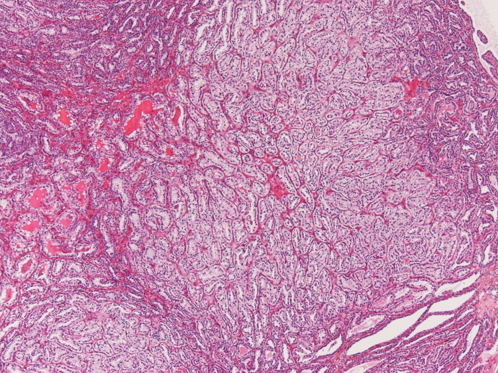 07C7074 | Classification of renal tumors