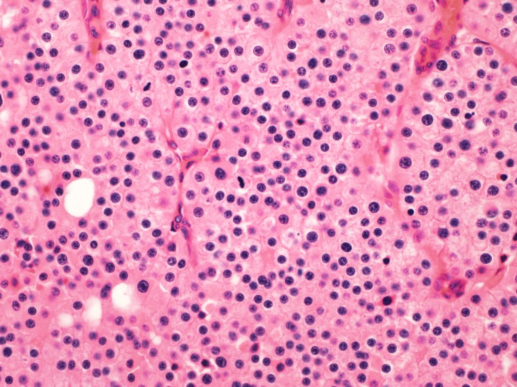 30 | Classification of renal tumors