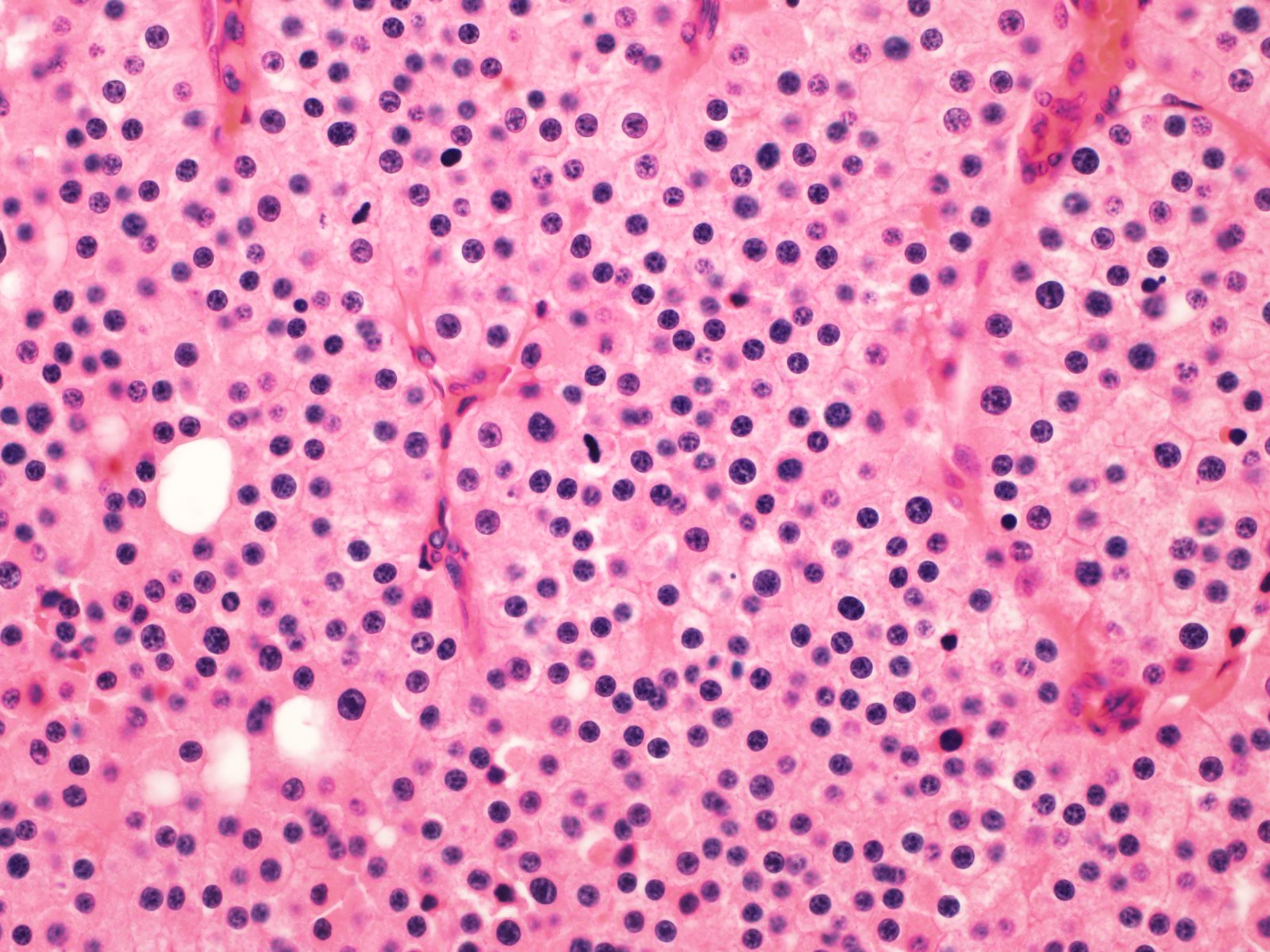 30 | Classification of renal tumors