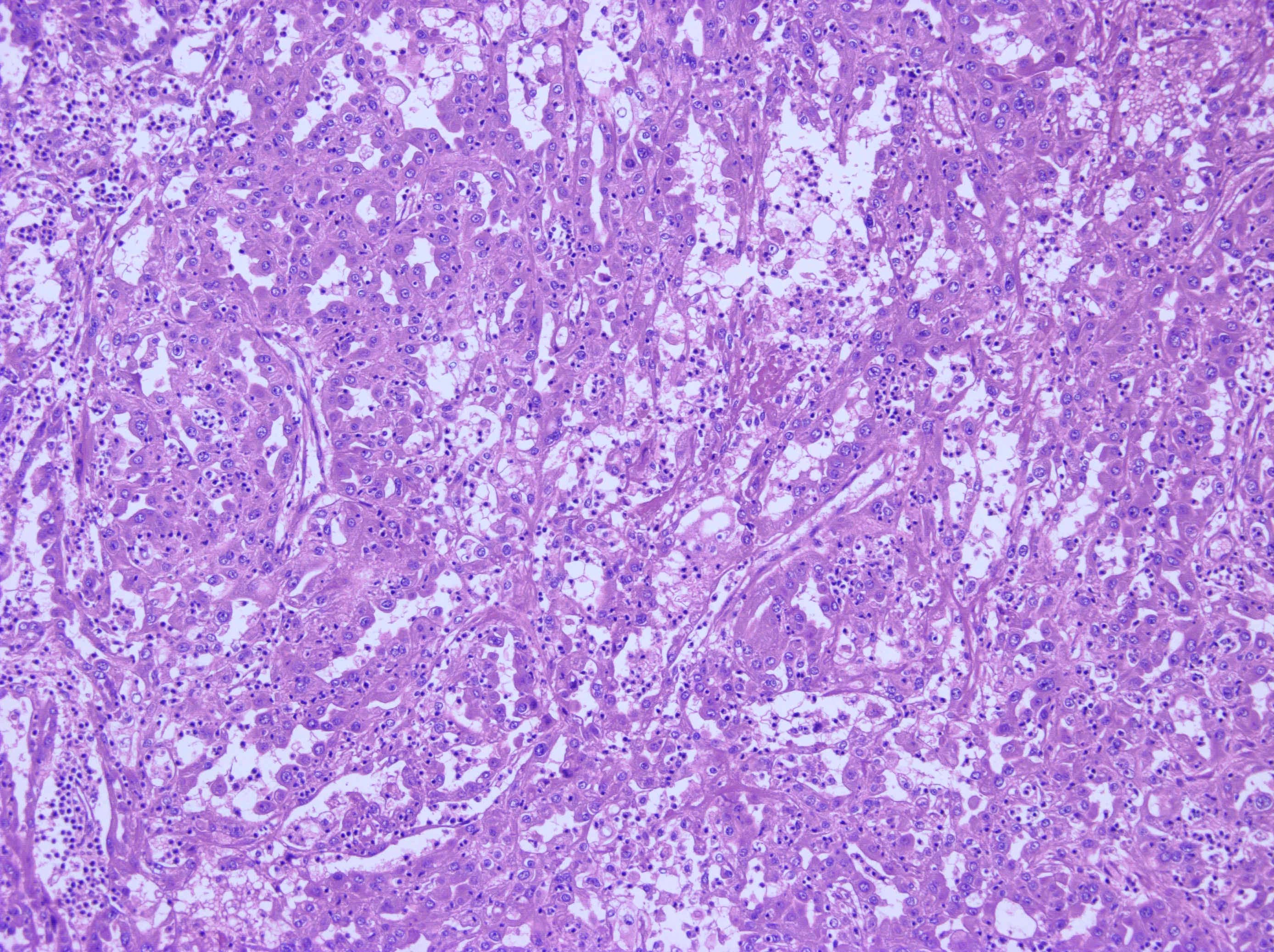 M133654/14 | Classification Of Renal Tumors