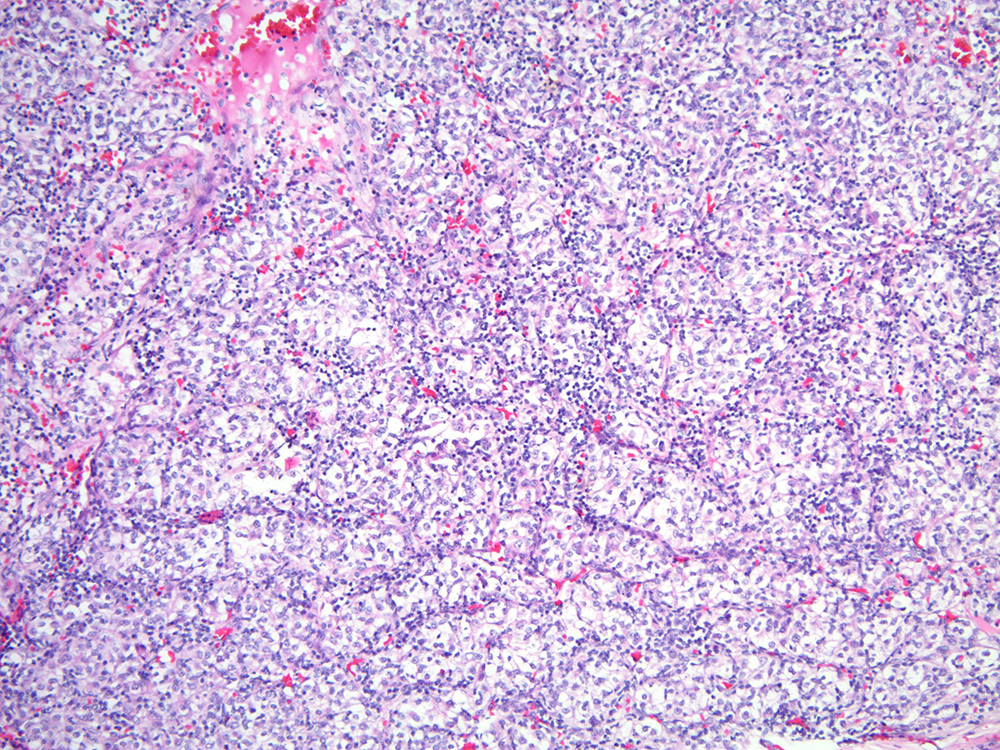 Jkm 2-16- 9 | Classification of renal tumors