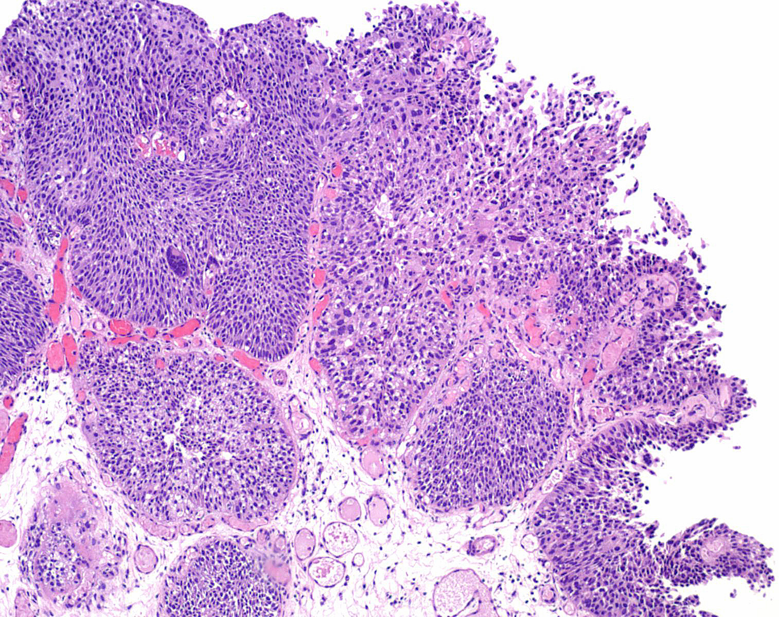 Papillary urothelial lesion of low malignant potential