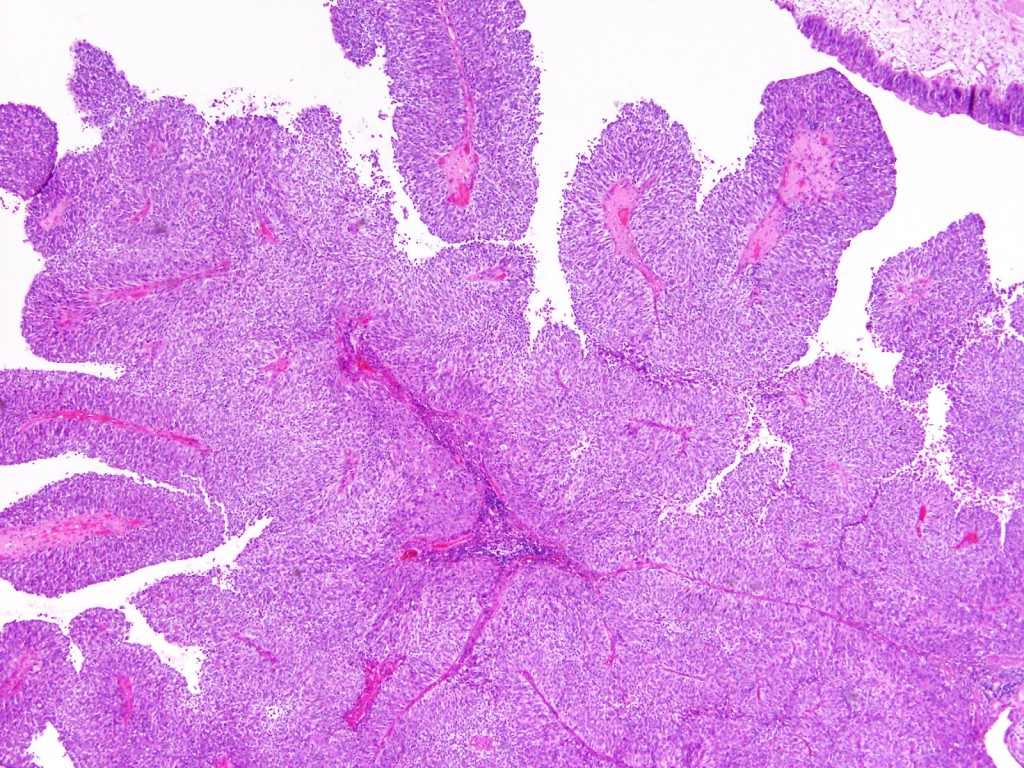 31187-bladder-papillary-lesions