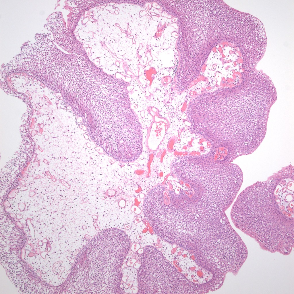 MBA3 | Bladder Papillary Lesions