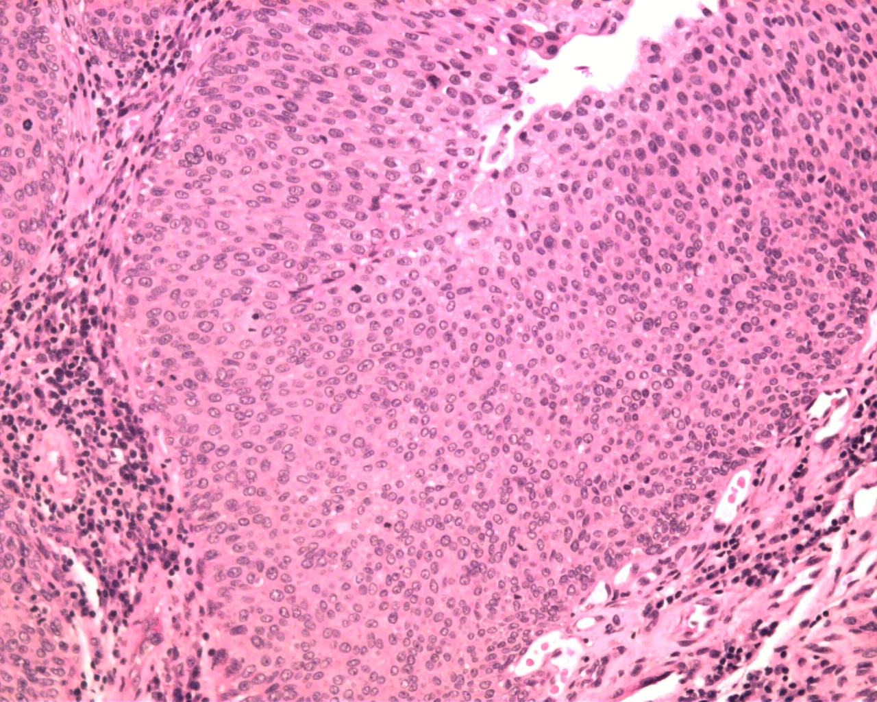 Case 7 | Bladder Papillary Lesions