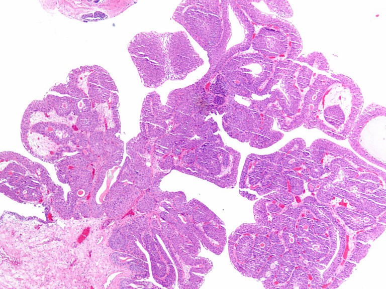 152476 | Bladder Papillary Lesions