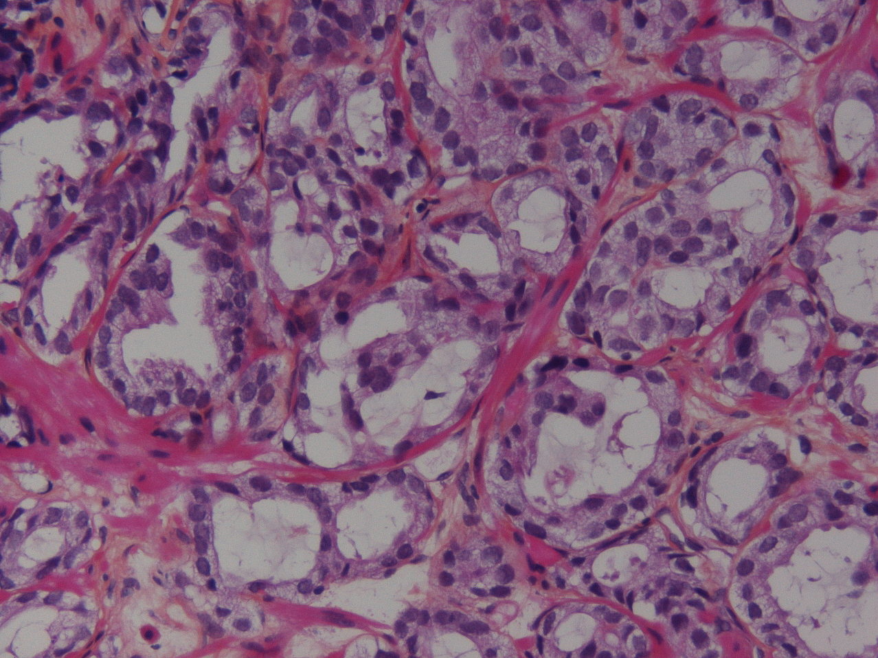 06C13145 | Prostate cancer grading