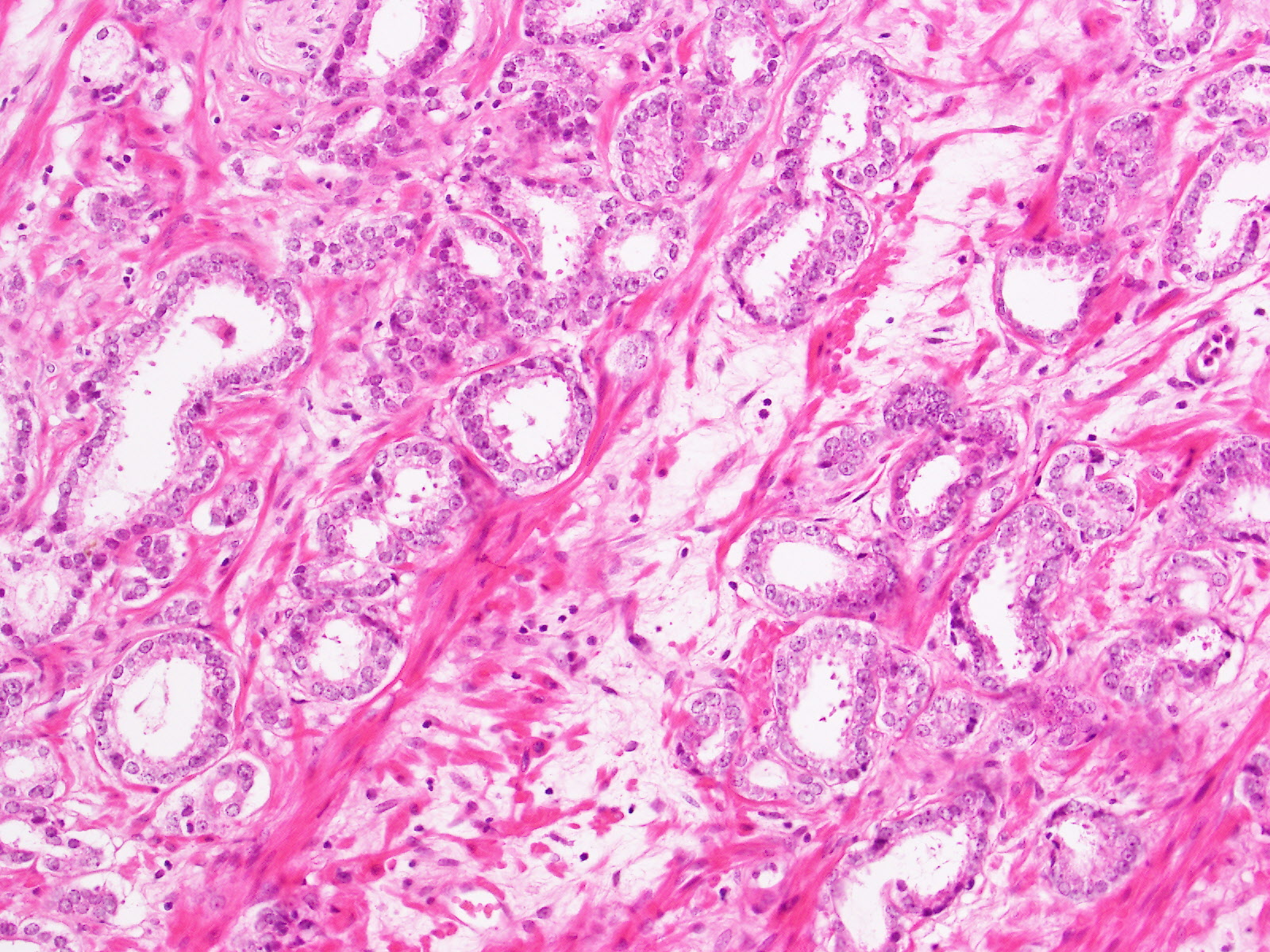 GK1 | Prostate cancer grading