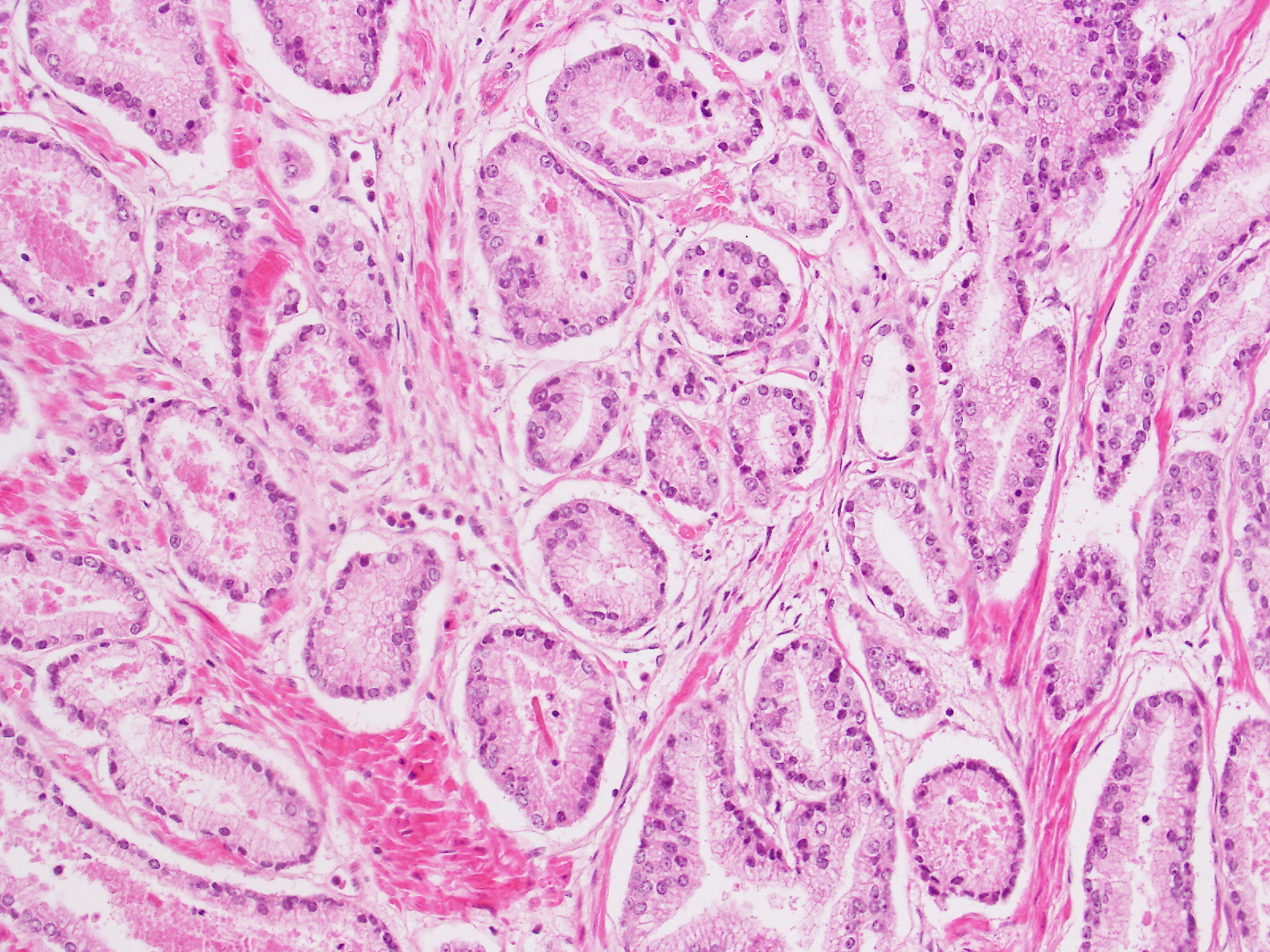 GK3 | Prostate cancer grading