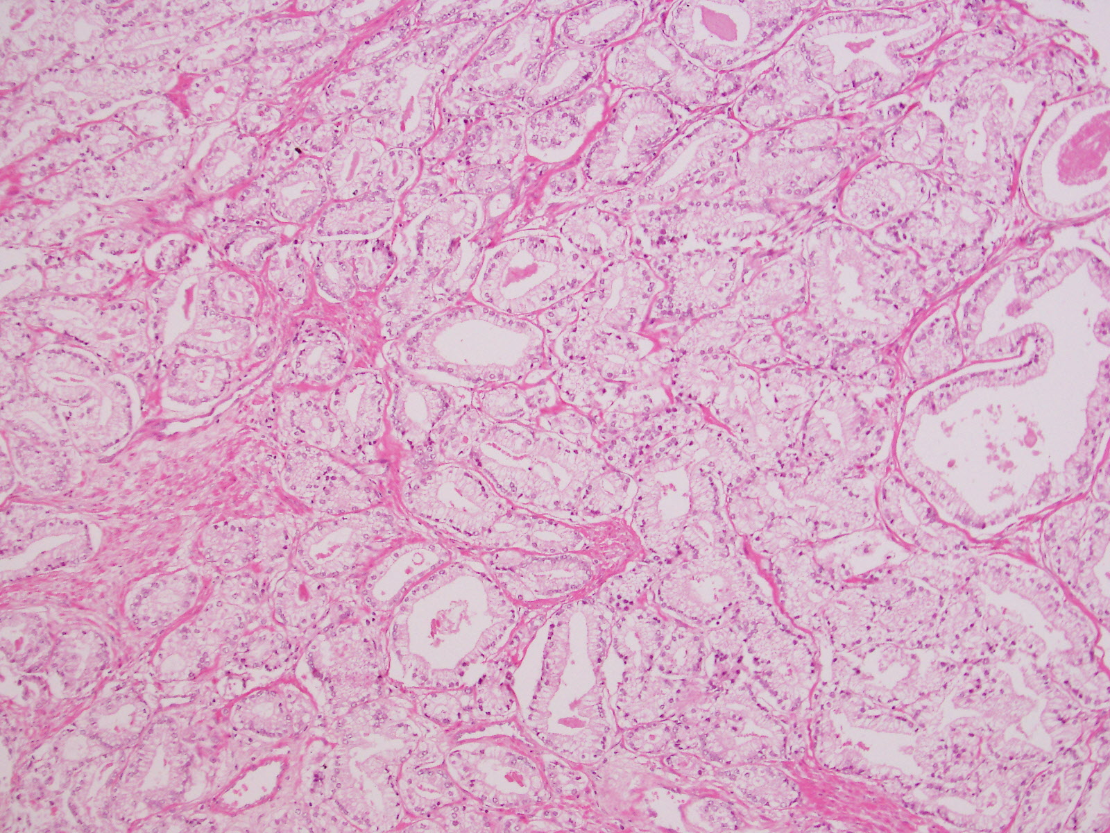 GK53 | Prostate cancer grading