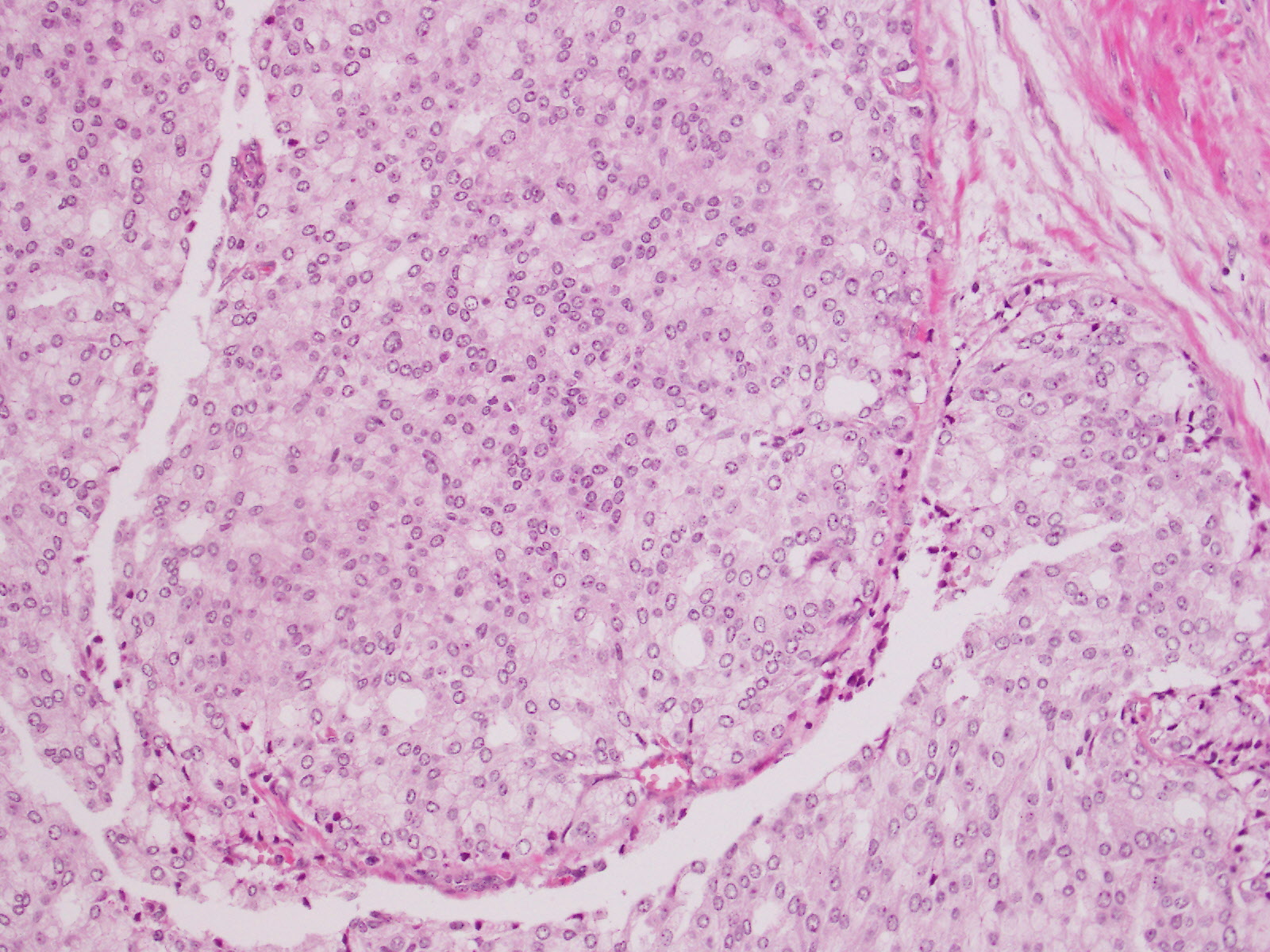 GK85 | Prostate cancer grading