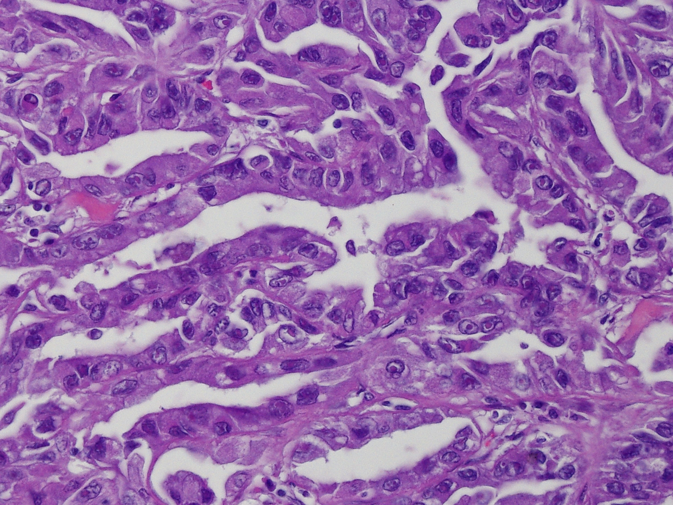 RN023 | Renal tumor grading