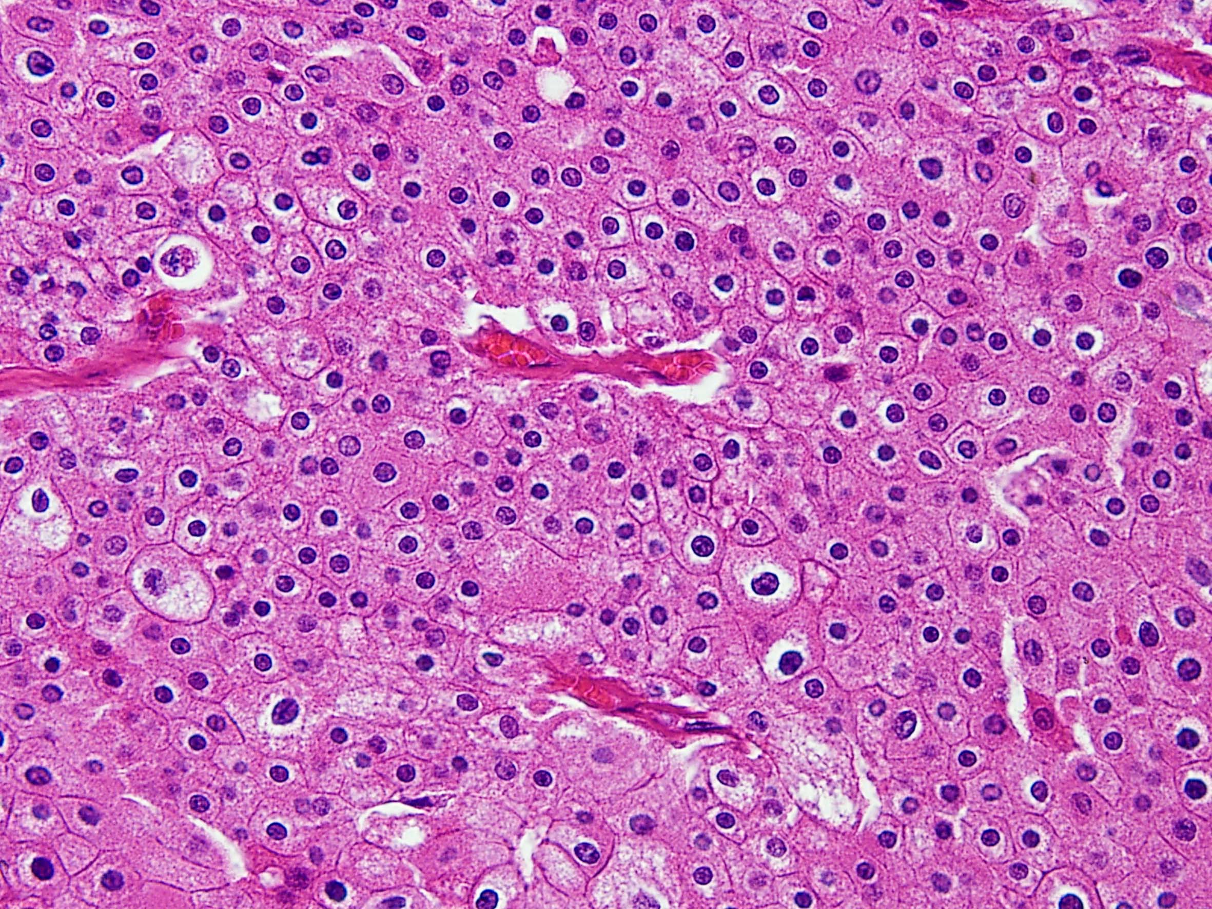 Renal Neoplasia 005 | Renal tumor grading